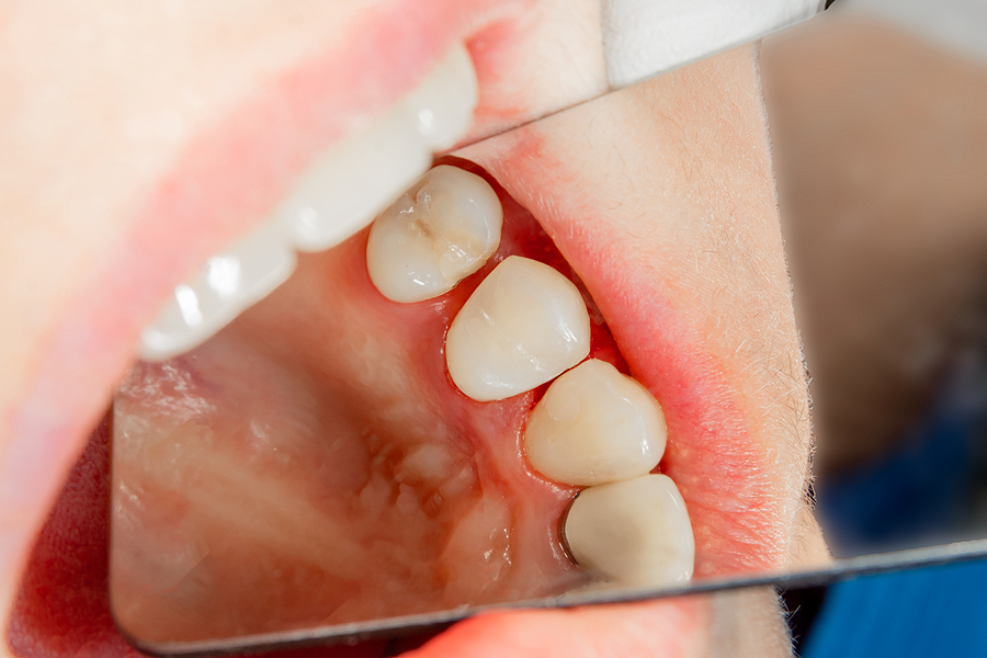 Protecting Young Smiles: The Importance of Sealants for Kids