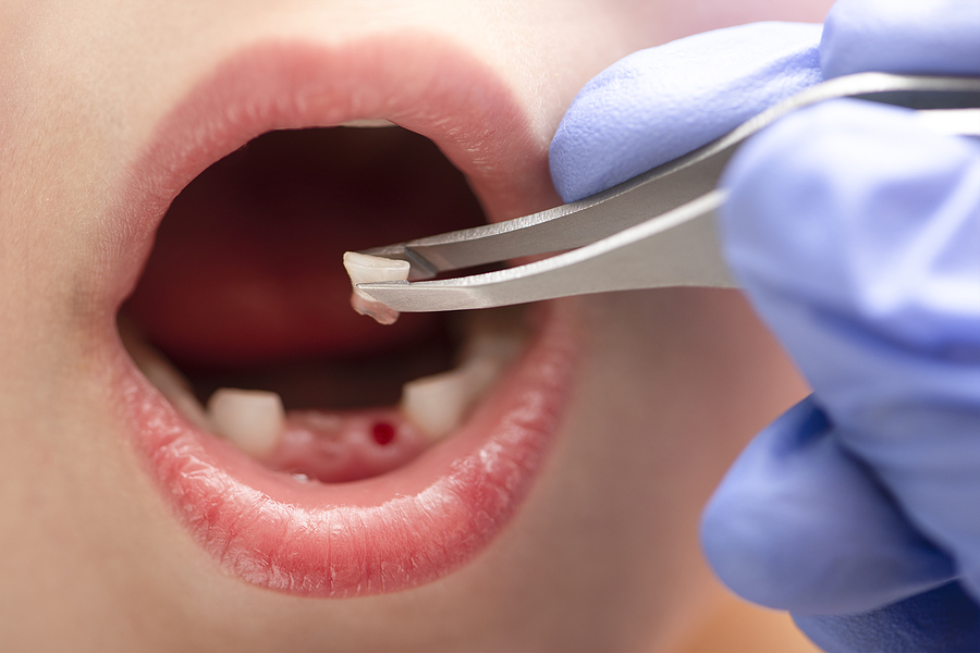 A Parent’s Guide to Tooth Extractions for Kids: What You Need to Know